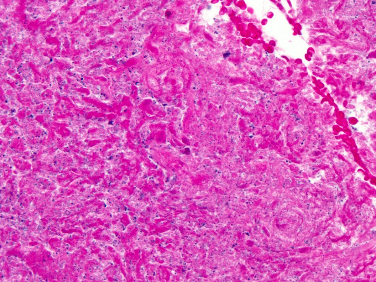 GMS, PAS and H&amp;E, in the same area in the necrotic center of a Histoplasma necrotizing granuloma