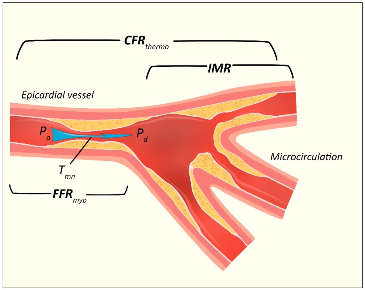 🚨 #CardioNuggets: 

Decoding Coronary Physiology in the Cath Lab 

CFR (Coronary Flow Reserve) = Total flow capacity   CFR = Normal &gt; 2.0

FFR (Fractional Flow Reserve) = Epicardial disease?
  FFR = Pd/Pa → Normal ≥ 0.80

 IMR (Index of Microcirculatory Resistance) =