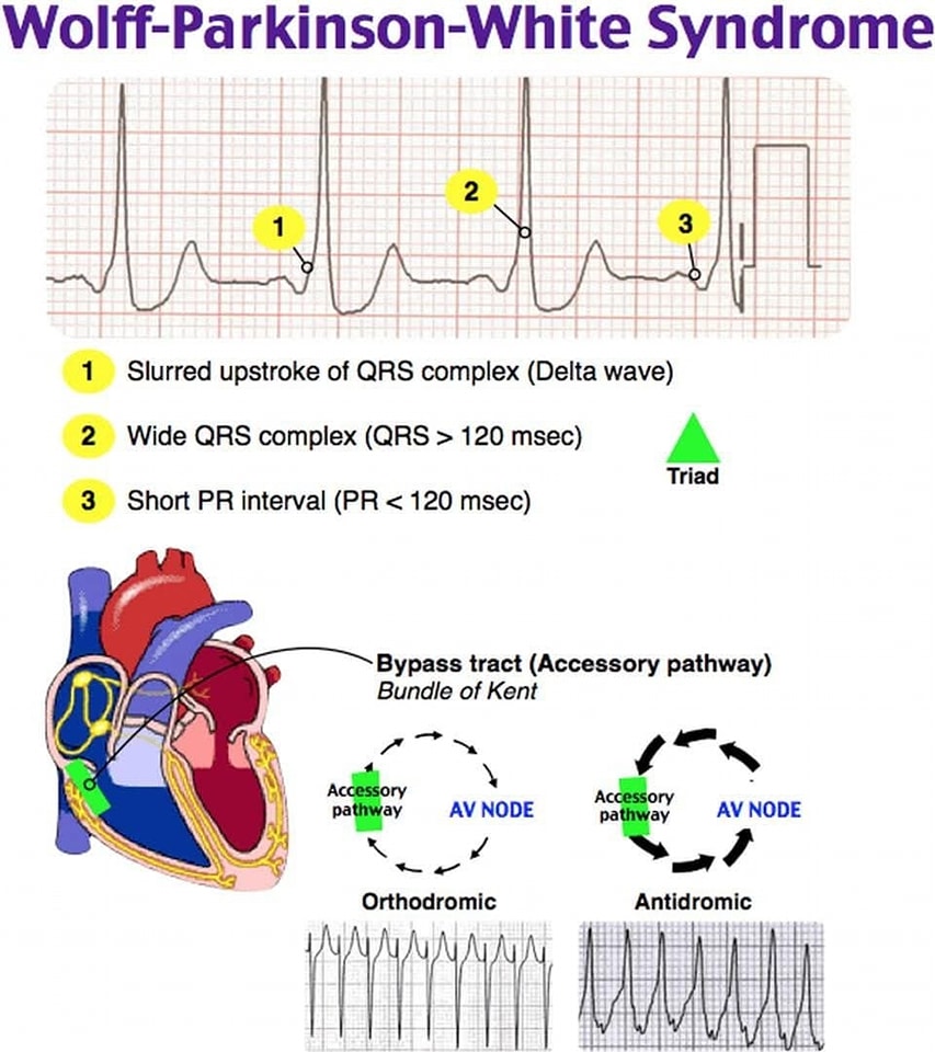ZHeart11768530's tweet photo. 🔴 Wolff-Parkinson-White Syndrome

WPW is one of several disorders of the electrical system of the heart that are commonly referred to as pre-excitation syndromes

 characterized by an abnormal accessory conduction pathway b/n the atria &amp; the ventricle known as the bundle of kent https://t.co/CeaukfFXeW