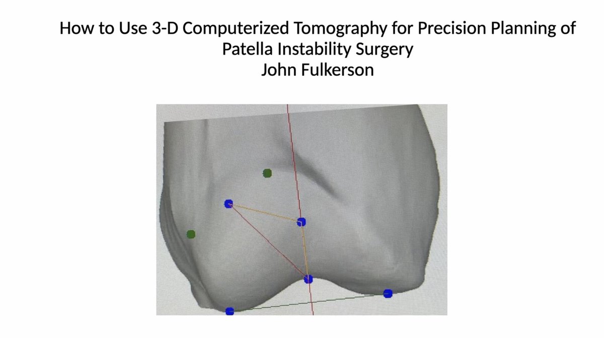 Dr. John Fulkerson of the Patellofemoral Foundation (PFF) highlights the critical role of 3D computerized tomography (CT) in precision planning for patellofemoral instability surgery in this short blog with video 👇

ow.ly/kZAQ50VvbSi