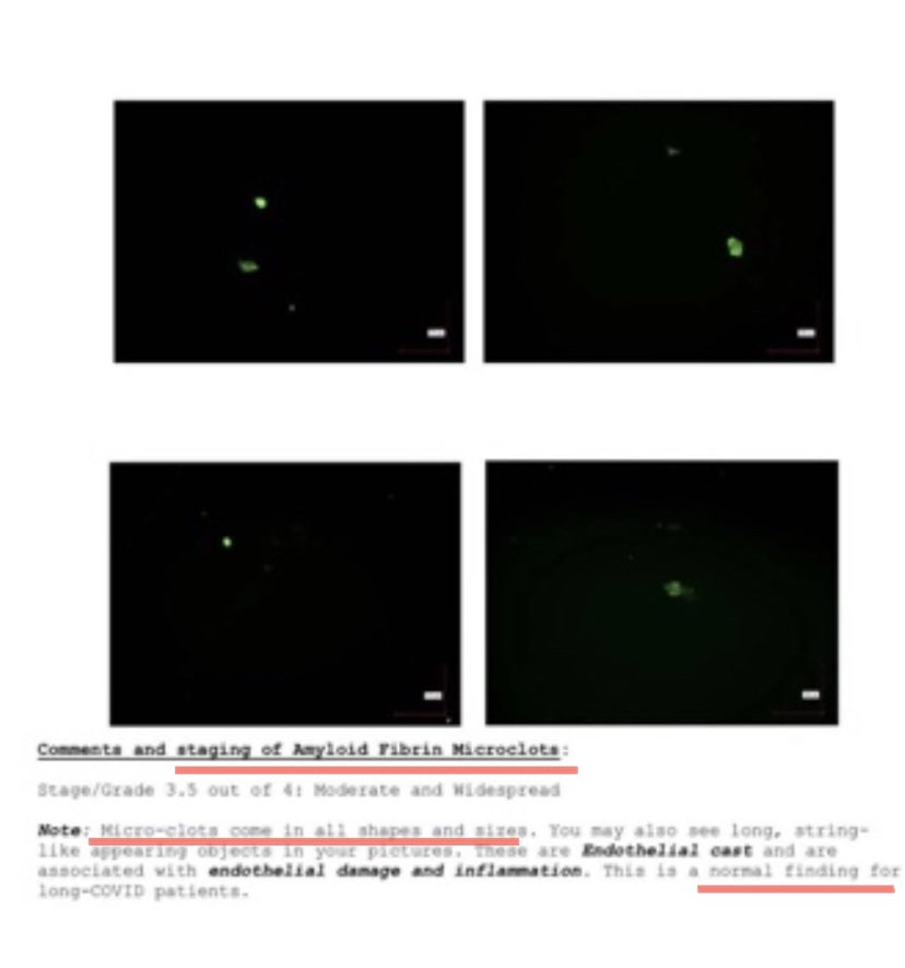 HORRIFYING RESULTS of WHITE FIBROUS CLOT TESTING FINDS “Alteration of Normal Ratio of 3 Fibrinogen Subcomponents from 1:1:1 Alpha:Beta:Gamma Strands TO ABNORMAL 9:4:1 Gamma:Alpha:Beta Strands”.
With conversion of fibrinogen to fibrin being altered, suspected fibrinogen