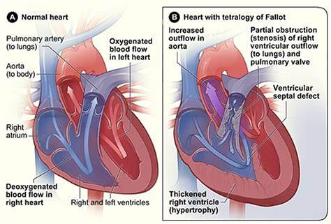 Tetralogy of Fallot (TOF) is a congenital heart defect  boot shaped heart with four abnormalities causing poor blood oxygenation

tetra (4)
- Ventricular Septal Defect (VSD)
- Pulmonary Stenosis
- Right Ventricular Hypertrophy
- Overriding Aorta