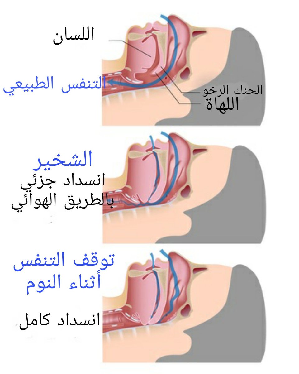 aboobada77's tweet photo. الشخير يحدث عندما يتدفق الهواء أمام الأنسجة المتراخية، مثل اللسان، والحنك الرخو  أثناء النوم. وتعمل الأنسجة المتراخية على تضييق مجرى الهواء، مما يؤدي إلى اهتزاز هذه الأنسجة. أما إذا سببت هذه الأنسجة المتراخية انسدادا كاملا عندها يحدث ما يسمى توقف التنفس أثناء النوم . https://t.co/1QnNxTyydU