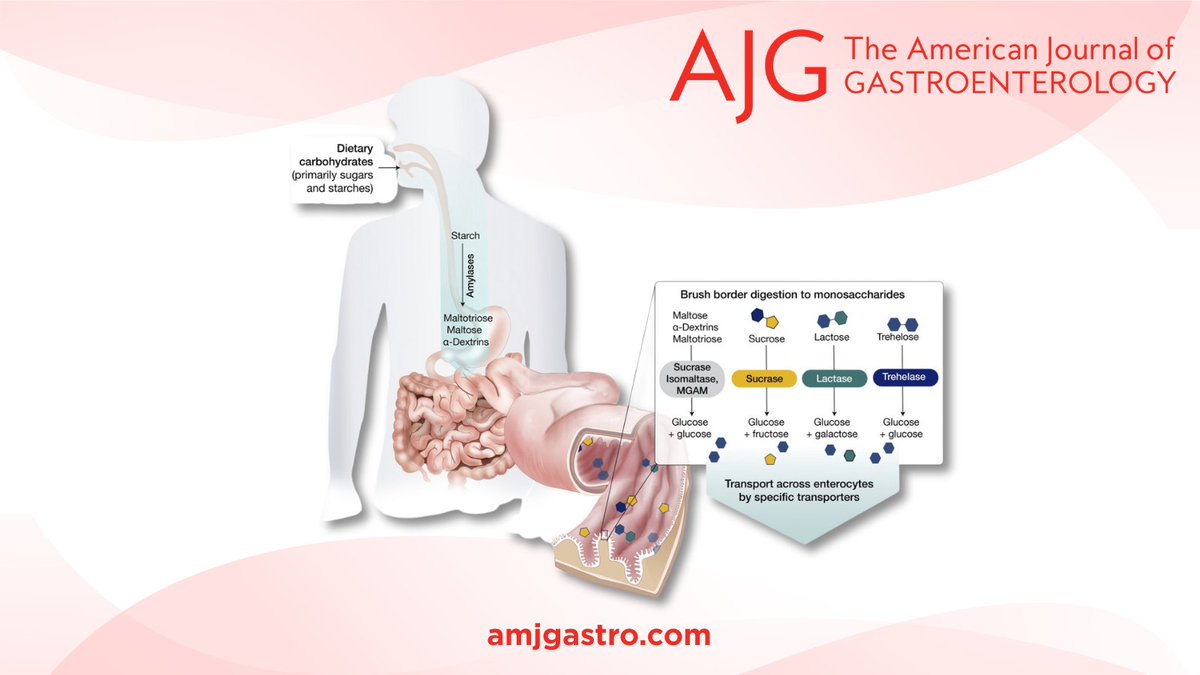 AJG - The American Journal of Gastroenterology (@amjgastro) on Twitter photo In the #RedJournal:
Supplement — Demystifying Carbohydrate Maldigestion: A Clinical Review
Brooks D. Cash, MD, FACG; Daksesh Patel, DO & Kate Scarlata, MPH, RDN
📕 bit.ly/3GhUN4q
<a href="/JasmohanBajaj/">Jasmohan Bajaj</a> <a href="/MLongMD/">Millie Long</a> <a href="/KateScarlata_RD/">Kate Scarlata, MPH, RDN</a> <a href="/AmCollegeGastro/">ACG</a> In the #RedJournal:
Supplement — Demystifying Carbohydrate Maldigestion: A Clinical Review
Brooks D. Cash, MD, FACG; Daksesh Patel, DO & Kate Scarlata, MPH, RDN
📕 bit.ly/3GhUN4q
<a href="/JasmohanBajaj/">Jasmohan Bajaj</a> <a href="/MLongMD/">Millie Long</a> <a href="/KateScarlata_RD/">Kate Scarlata, MPH, RDN</a> <a href="/AmCollegeGastro/">ACG</a>