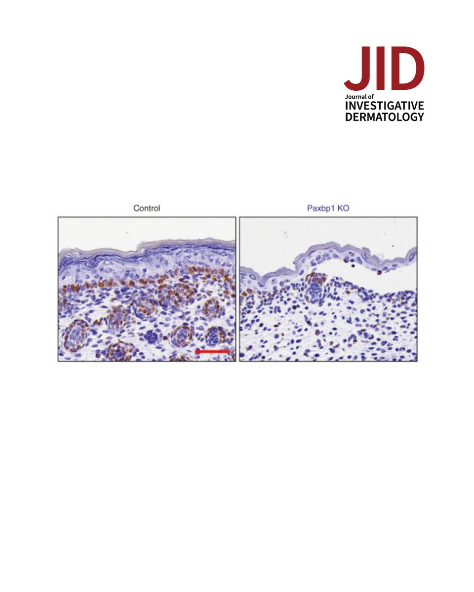 theJIDJournal's tweet photo. Huang et al report Paxbp1 Is Indispensable for the Maintenance of #Epidermal Homeostasis.
https://t.co/naRYkoKenn
#dermtwitter #dermatology #dermscience #dermresearch https://t.co/8KIrAlb1IF
