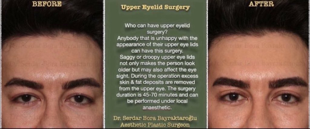 Clinicsbbintl's tweet photo. UPPER EYELID SURGERY 

Erase your tired expression with eyelid surgery

#clinicsbbinternational #uppereyelidsurgery #uppereyelid #eyelidsurgery #before #after #beforeafter #result https://t.co/ZY6iM2PAM1