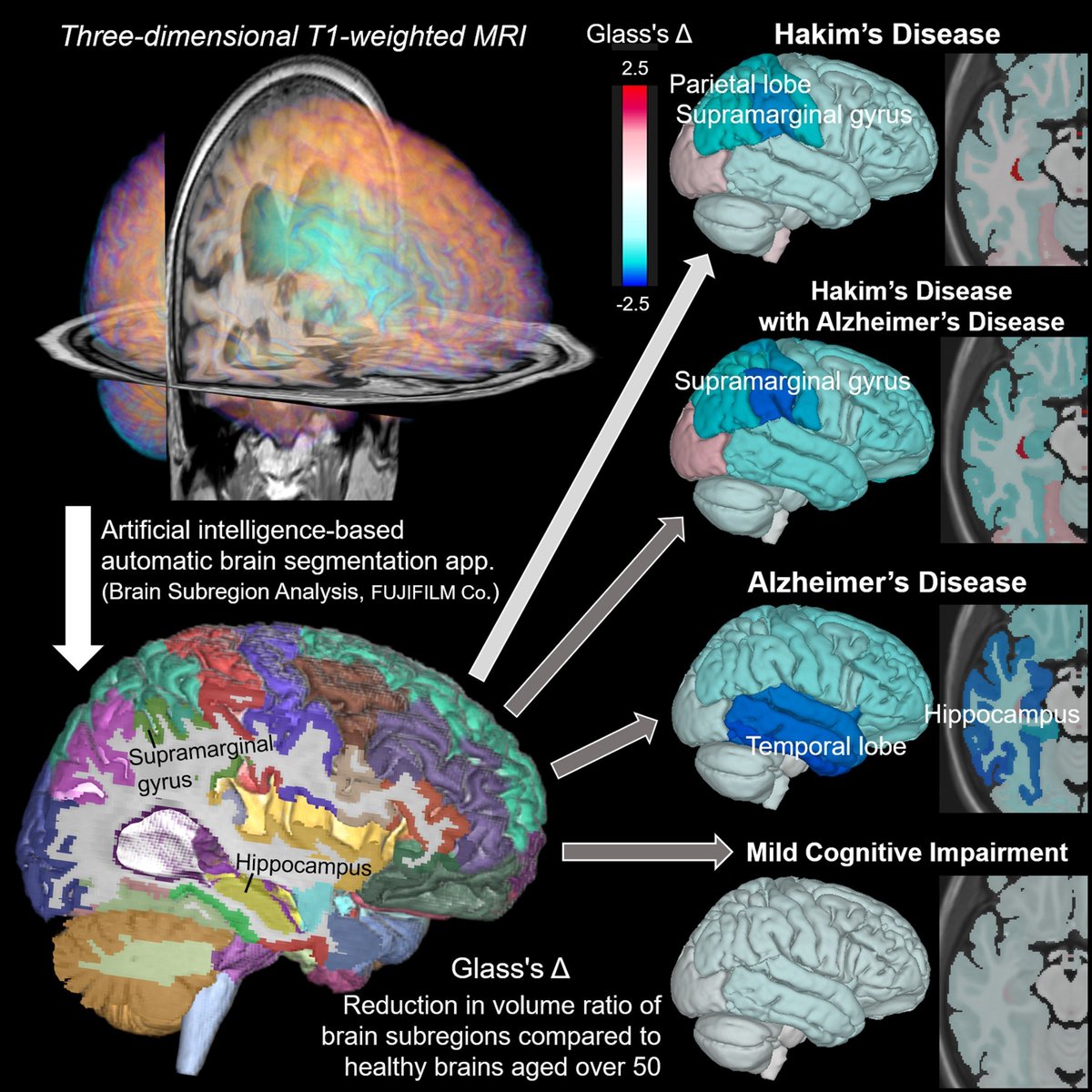 braincomms's tweet photo. Yamada et al. identified distinct brain volume patterns in idiopathic normal-pressure hydrocephalus, Alzheimer’s, and mild cognitive impairment, aiding in differential diagnosis. Please read at: https://t.co/O470jPP44R https://t.co/zcsJyZpsg1
