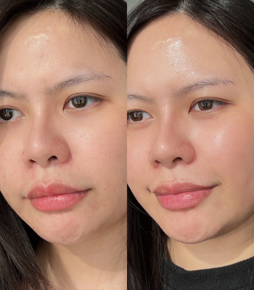 34 ยังไงให้หน้าไม่ไปไกลเท่าอายุ นอกจากโบท็อกซ์ ก็มี Epicelline® Serum จาก Eucerin นี่แหละ ที่ใช้ควบคู่กับหัตถการยกกระชับผิวเด็กแล้วได้ผลลัพธ์ดีมากก นอกจากผิวฟูกระชับ ยังชุ่มชื้นอิ่มน้ำ ไม่แห้งกร้านต้นเหตุของริ้วรอยแรกเริ่ม ผิวเรียบเนียน นุ่มเด้ง ย้อนอายุผิวได้เป็นสิบปีเลย
ทางแบรนด์เค้าคิดค้นมาจากศาสตร์ของ Epigenetics ซึ่งเป็นการศึกษาเกี่ยวกับการร่วงโรยของผิวถึงระดับเซลล์ผิวเลย เซรั่มขวดนี้มันเลยเป็นเซรั่มลดริ้วรอยที่เก่ง และเห็นผลดีมากๆ สำหรับคนที่ใกล้เข้าเลข3ควรมีติดรูทีนไว้เลย