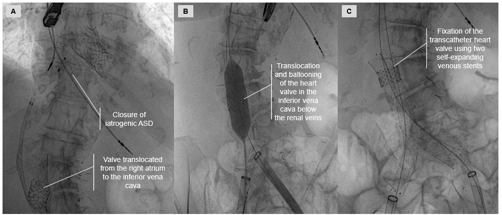 Gennaro Giustino, MD (@g_giustinomd) on Twitter photo First-in-human percutaneous transseptal Retrieveal of Embolized TRanscatheter valve In the lEft VEntricle (RETRIEVE)
Now in press in JACC CVI
Thank you to the patient/family and the Morristown team for the trust and support in me for this great save.
<a href="/PhilGenereuxMD/">Philippe Genereux</a> First-in-human percutaneous transseptal Retrieveal of Embolized TRanscatheter valve In the lEft VEntricle (RETRIEVE)
Now in press in JACC CVI
Thank you to the patient/family and the Morristown team for the trust and support in me for this great save.
<a href="/PhilGenereuxMD/">Philippe Genereux</a>