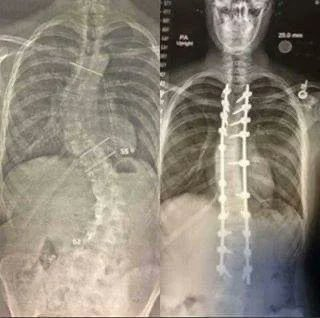 Jefersonnasa_'s tweet photo. 13. Radiografía de la espalda de una persona antes y después de una operación de escoliosis. La operación duró 14 horas. Los cirujanos perforaron varillas de metal en la columna vertebral. https://t.co/dm3fQzAur5