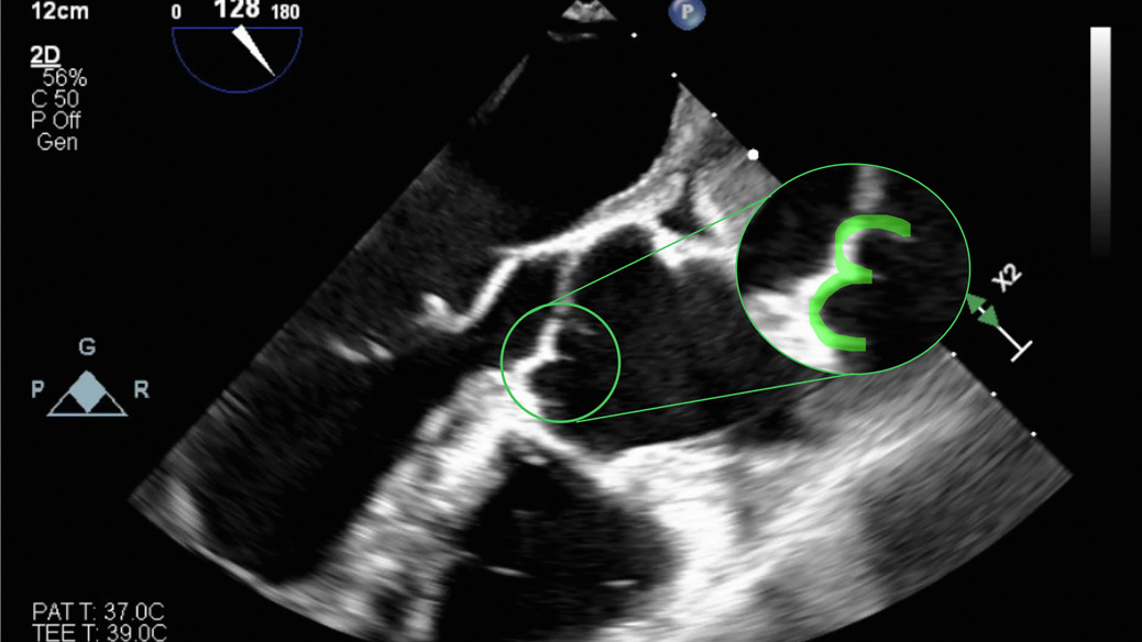 ✨ Check out our latest  <a href="/AATSHQ/">AATS</a> #JTCVS Techniques publication on a novel echocardiographic W sign in aortic valve regurgitation🫀. Authors include Drs. <a href="/GabeWeininger/">Gabe Weininger MD</a>, <a href="/mattwingoMD/">Matt Wingo</a>, and Joseph Woo. 🌟 Read more: ow.ly/xlIs50VBTMs