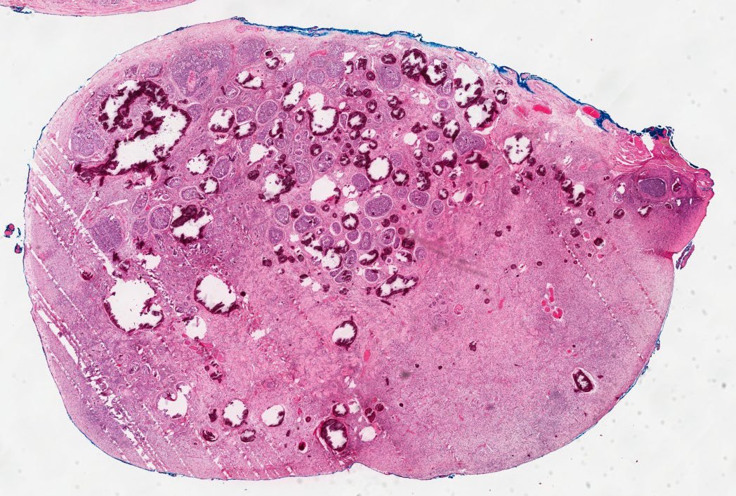Path4People's tweet image. I am strongly associated with Disorders of Sex Development 

I can be seen in Undescended Testes

I am benign but have a risk (8-10%) of undergoing malignant transformation.

Who am I? 🤔 

📸 Credit: Robert O Brady, MD

#pedipath #peds #endocrine #pathx