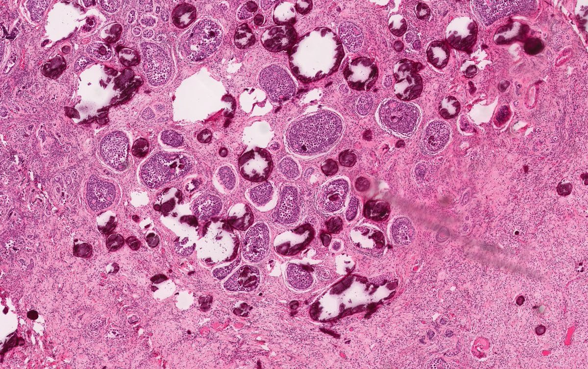 Path4People's tweet image. I am strongly associated with Disorders of Sex Development 

I can be seen in Undescended Testes

I am benign but have a risk (8-10%) of undergoing malignant transformation.

Who am I? 🤔 

📸 Credit: Robert O Brady, MD

#pedipath #peds #endocrine #pathx