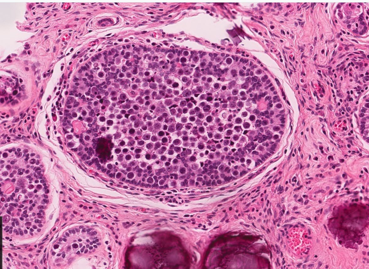 Path4People's tweet image. I am strongly associated with Disorders of Sex Development 

I can be seen in Undescended Testes

I am benign but have a risk (8-10%) of undergoing malignant transformation.

Who am I? 🤔 

📸 Credit: Robert O Brady, MD

#pedipath #peds #endocrine #pathx