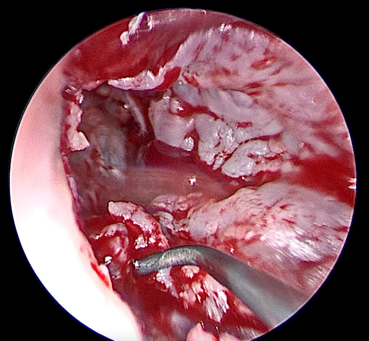 Totally #endoscopic approach to #temporomandibular joint hernia mistaken for diffuse external ear infection 👂🏼🦠
Pt refered with severe pain on chewing, so far only external approaches described😎
Any similar experiences, anyone?🤔
<a href="/WIMWarszawa/">WIM-PIB</a> <a href="/IWGEES_EES/">EndoscopicEarSurgery</a>