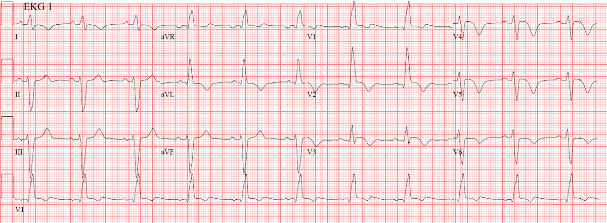 smithECGBlog's tweet photo. Never send a chest pain patient home without measuring troponin. What is masquerading bundle branch block? And, and, and....

https://t.co/eXVDdLTFEp https://t.co/Q8Qnqc41eu