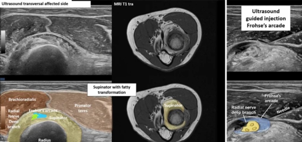 Ultrasound imaging-based diagnosis of deep branch radial nerve entrapment
from <a href="/ramicheroli/">Raphael Micheroli</a> <a href="/riccivincenzo17/">Vincenzo Ricci</a> <a href="/mbecciomd/">Ultrasound Imaging</a> 

link.springer.com/article/10.100…
