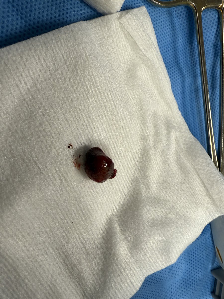 RussellKirkDDS's tweet photo. This was the case of the day for me.

It was interesting because there were two distinct areas of pathology.

The mesial neoplasm was clinically consistent with an OKC.

The other neoplasm is the one in the attached photo. It was superior and distal to the crown of #32.

I sent both of them to pathology for review and definitive diagnosis.