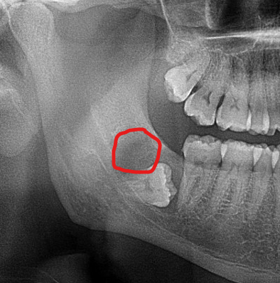 RussellKirkDDS's tweet photo. This was the case of the day for me.

It was interesting because there were two distinct areas of pathology.

The mesial neoplasm was clinically consistent with an OKC.

The other neoplasm is the one in the attached photo. It was superior and distal to the crown of #32.

I sent both of them to pathology for review and definitive diagnosis.
