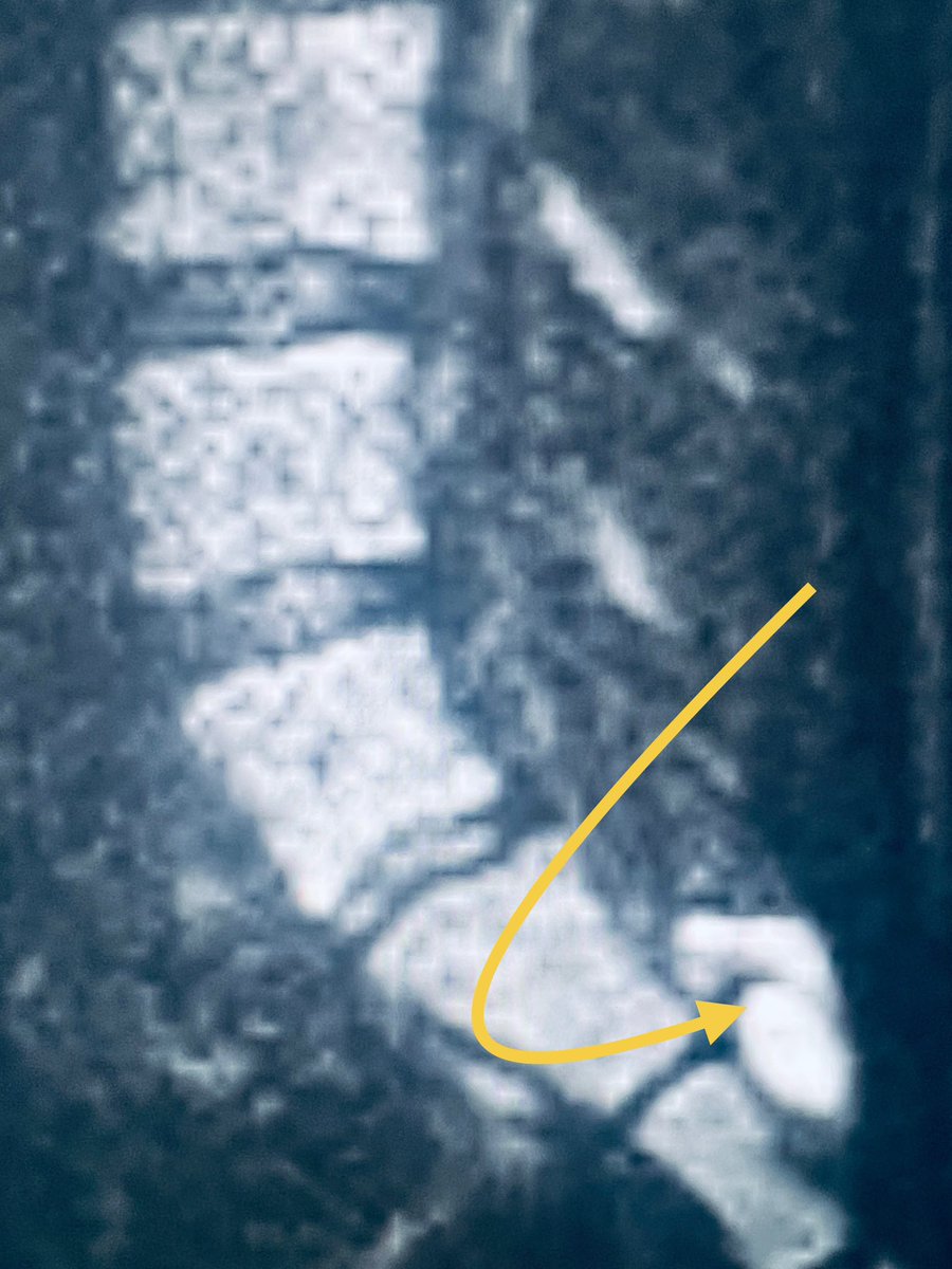 Read on, here’s the weekly #SPIN-#POV. If you encounter a cystic lesion where a previous myelomeningocele was repaired, proceed to perform diffusion imaging. An epithelial inclusion cyst will light up like here. These can grow and surgeons are keen to get them out.