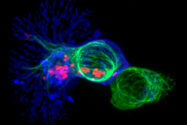 Cell Therapy News (@celltherapynews) on Twitter photo 🧪 Collaborators report on a 45-year-old woman with treatment-refractory Jo-1-associated anti-synthetase syndrome, who initially achieved disease remission after CD19-CAR T-cell therapy but then experienced disease relapse after 9 months.
<a href="/NatureMedicine/">Nature Medicine</a> | 🧪 Collaborators report on a 45-year-old woman with treatment-refractory Jo-1-associated anti-synthetase syndrome, who initially achieved disease remission after CD19-CAR T-cell therapy but then experienced disease relapse after 9 months.
<a href="/NatureMedicine/">Nature Medicine</a> |