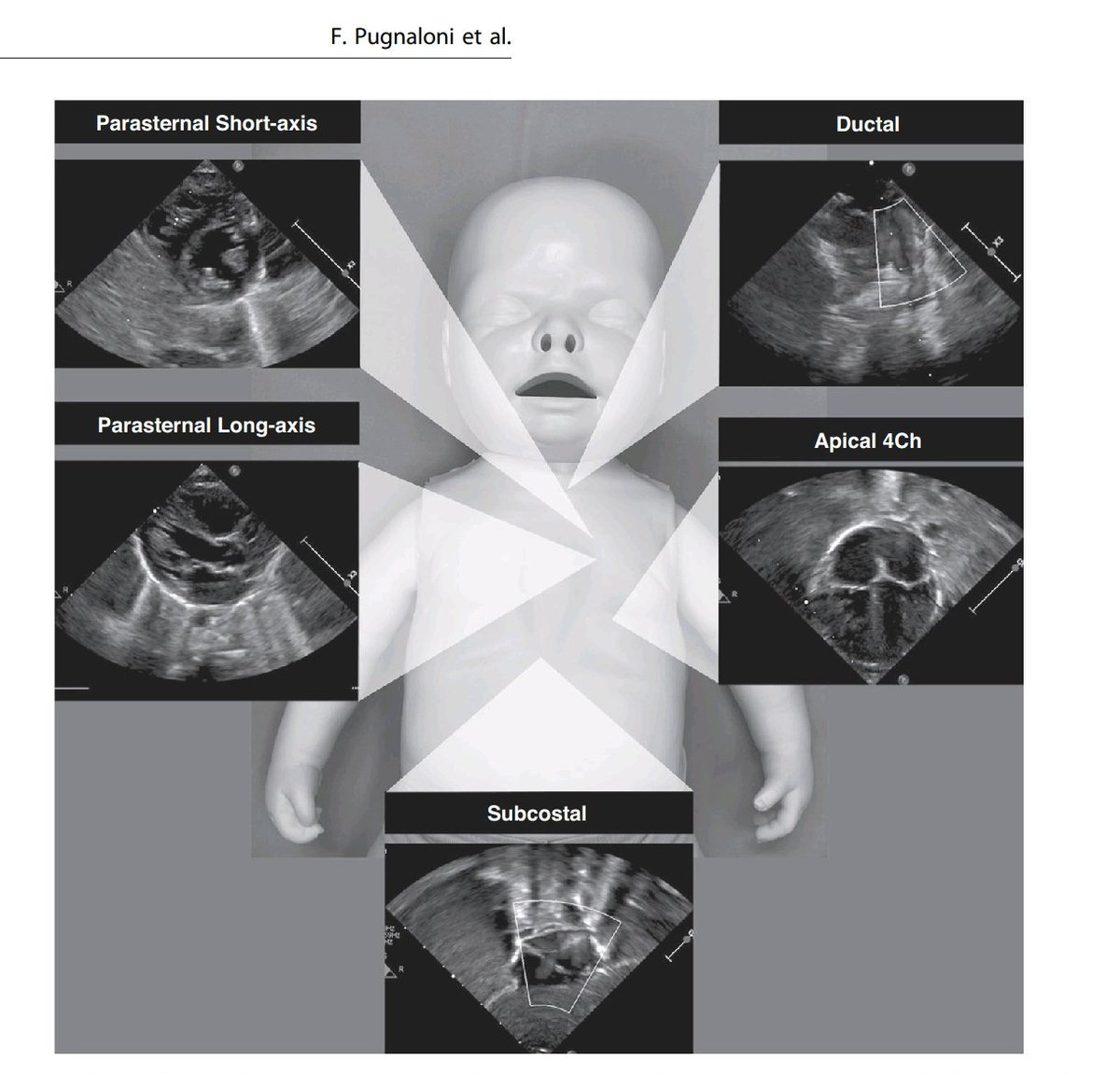LaLoTomas3's tweet image. Evaluación por ECOTT de disfunción Hemodinámica 🫀 en neonatos 👶🏻 con sepsis 🦠

Evaluar Presión Pulmonar 🫁
Función Diastólica 🫀
Función Sistólica 🫀
Identificar fisiología del shock 🦠🩸

#FirstECHO #UsCaPeD #CardioHack

@USPed_Latam @USPed_Latino