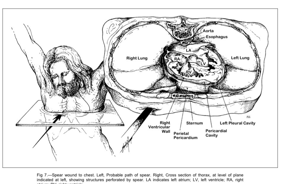 LeonardoSotoMu's tweet photo. De qué murió Jesús de Nazareth:
A) Shock hipovolemico
B) Asfixia 
C) infarto al miocardio
D) otras 
https://t.co/yYsuDglpgo https://t.co/lkrhj5Aa0f