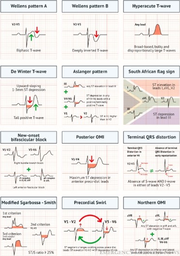 Emergency Medicine News (@emnews) on Twitter photo I reviewed a case where paramedics diagnosed a STEMI, but the 1st physician disagreed. A second ECG confirmed it, and the patient got timely treatment. RI & MA ERs are the 3rd & 4th most crowded in the US. Importance of thorough diagnostics! <a href="/matt_bivens/">Matt Bivens, MD</a>
ow.ly/FlqY50VCUXT I reviewed a case where paramedics diagnosed a STEMI, but the 1st physician disagreed. A second ECG confirmed it, and the patient got timely treatment. RI & MA ERs are the 3rd & 4th most crowded in the US. Importance of thorough diagnostics! <a href="/matt_bivens/">Matt Bivens, MD</a>
ow.ly/FlqY50VCUXT