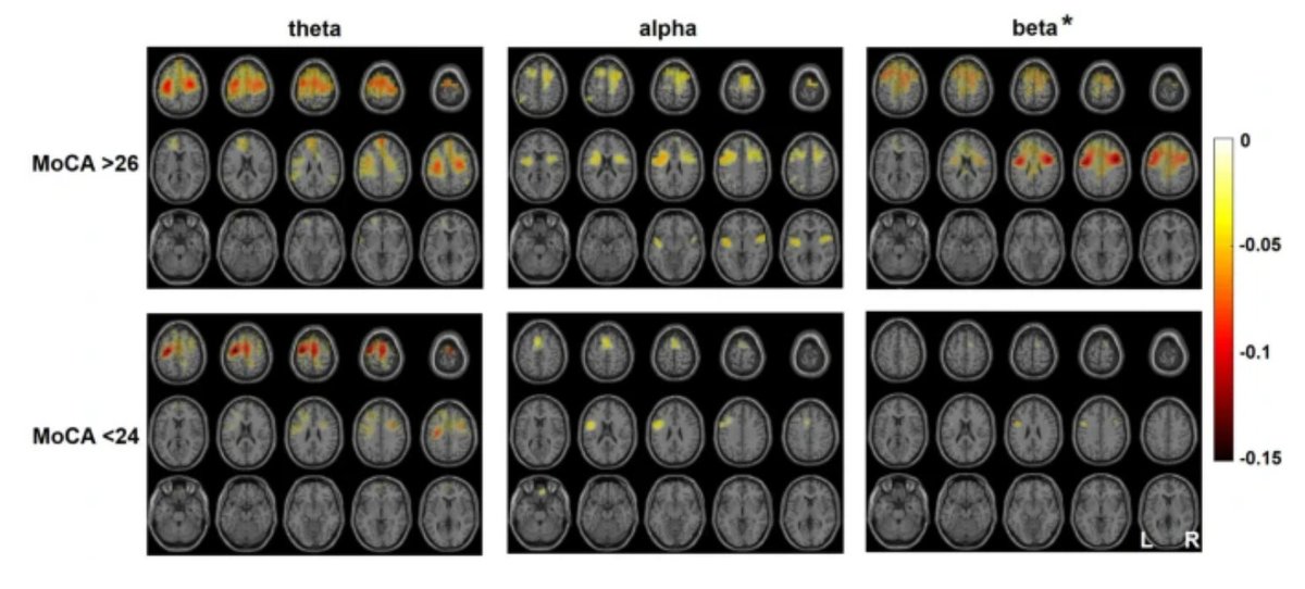 GeroScienceAGE's tweet photo. 📢New Open🔓 Access Paper in GeroScience

Cognitive decline limits compensatory resource allocation within the aged swallowing network by Sonja Suntrup-Krueger & Bendix Labeit (@BendixLabeit) et al.

https://t.co/rfuPapQUYu

#presbyphagia #swallowing #CognitiveDecline #DualTask #olderpeople #Magnetoencephalography