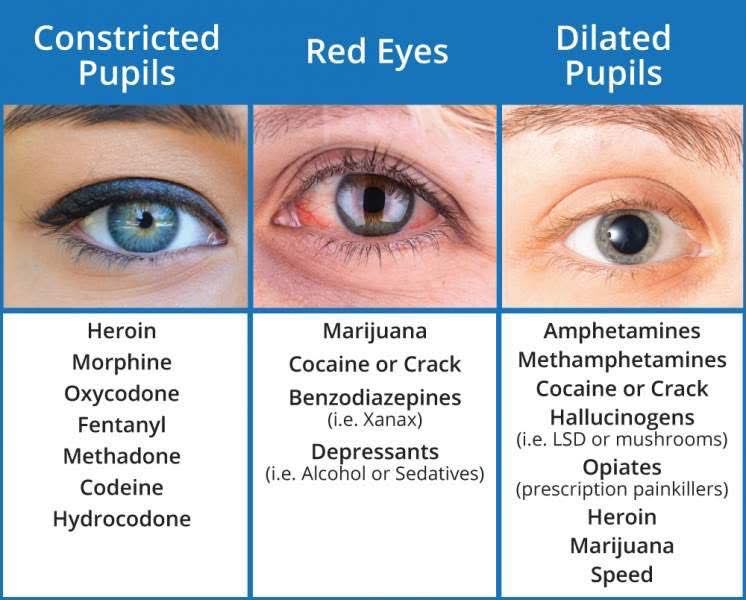 OGdukeneurosurg's tweet photo. Eye findings https://t.co/xVyAHlNqoj