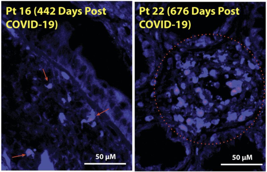 Ralf Wittenbrink (@rwittenbrink) on Twitter photo Krebs als eine mögliche Folge von Long-COVID
„Personen mit einer früheren COVID-Infektion haben ein völlig gestörtes Immunsystem, was die Tumorentwicklung begünstigt, weil Gene hochreguliert werden, die das Immunsystem in einen Suppressorzustand versetzen, wodurch Tumorzellen … Krebs als eine mögliche Folge von Long-COVID
„Personen mit einer früheren COVID-Infektion haben ein völlig gestörtes Immunsystem, was die Tumorentwicklung begünstigt, weil Gene hochreguliert werden, die das Immunsystem in einen Suppressorzustand versetzen, wodurch Tumorzellen …