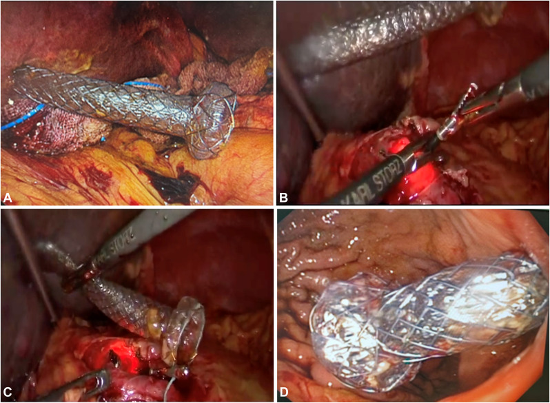 GIE_Journal's tweet photo. At the Focal Point, Chen et al try "Rescue laparoscopy-assisted repositioning of a misdeployed metal stent in the peritoneum after EUS-guided hepaticogastrostomy (with video)." https://t.co/116dAgaPeA https://t.co/QGohjOXTxR