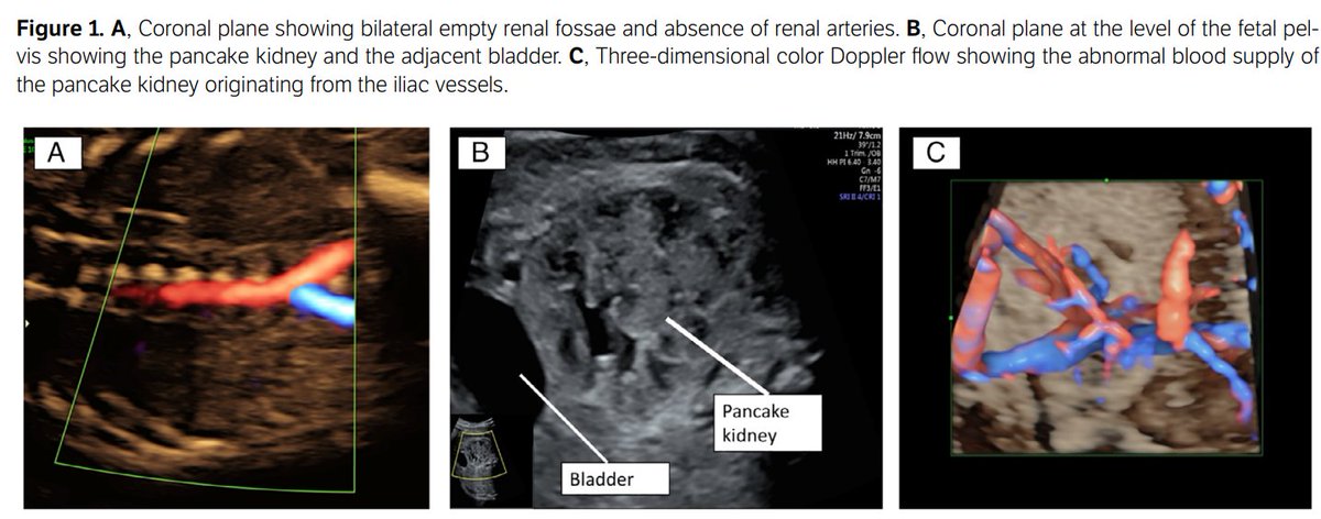 #Pocus for #Medstudents
What the hell is ...........  
The Pancake Kidney? 😱 

Here 👉doi.org/10.1002/jum.15…
Something on this rare congenital fusion defect