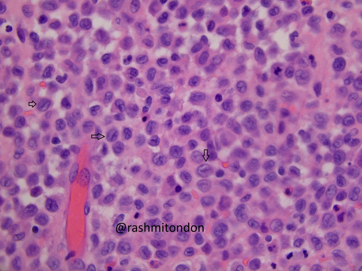 Rashmi Tondon (@rashmitondon) on Twitter photo Happy Friday everyone! Langerhans cell histiocytosis (LCH), presenting as an anal lesion. Coffee-bean like nuclei, nuclear grooves, admixed eosinophils, +S100/CD1a/Langerin. GIT involvement is rare. PMID: 38897453. #pathology <a href="/PennPathLabMed/">Penn Path & Lab Medicine</a> Happy Friday everyone! Langerhans cell histiocytosis (LCH), presenting as an anal lesion. Coffee-bean like nuclei, nuclear grooves, admixed eosinophils, +S100/CD1a/Langerin. GIT involvement is rare. PMID: 38897453. #pathology <a href="/PennPathLabMed/">Penn Path & Lab Medicine</a>
