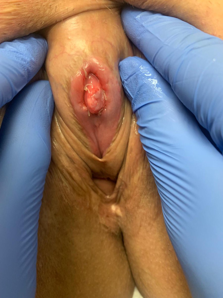 Kirtishri Mishra (@kirtishrim) on Twitter photo Patient s/p vaginoplasty with severe clitoral adhesions and complete burial. Referred for reconstruction. Underwent unburial of clitoris and buccal graft resurfacing. Last picture at 3 weeks after surgery. Continues to have great sensation. <a href="/metrohealthCLE/">MetroHealth</a> <a href="/GenderSurgeons/">TransHealthCare - transhealth.bsky.social</a> Patient s/p vaginoplasty with severe clitoral adhesions and complete burial. Referred for reconstruction. Underwent unburial of clitoris and buccal graft resurfacing. Last picture at 3 weeks after surgery. Continues to have great sensation. <a href="/metrohealthCLE/">MetroHealth</a> <a href="/GenderSurgeons/">TransHealthCare - transhealth.bsky.social</a>