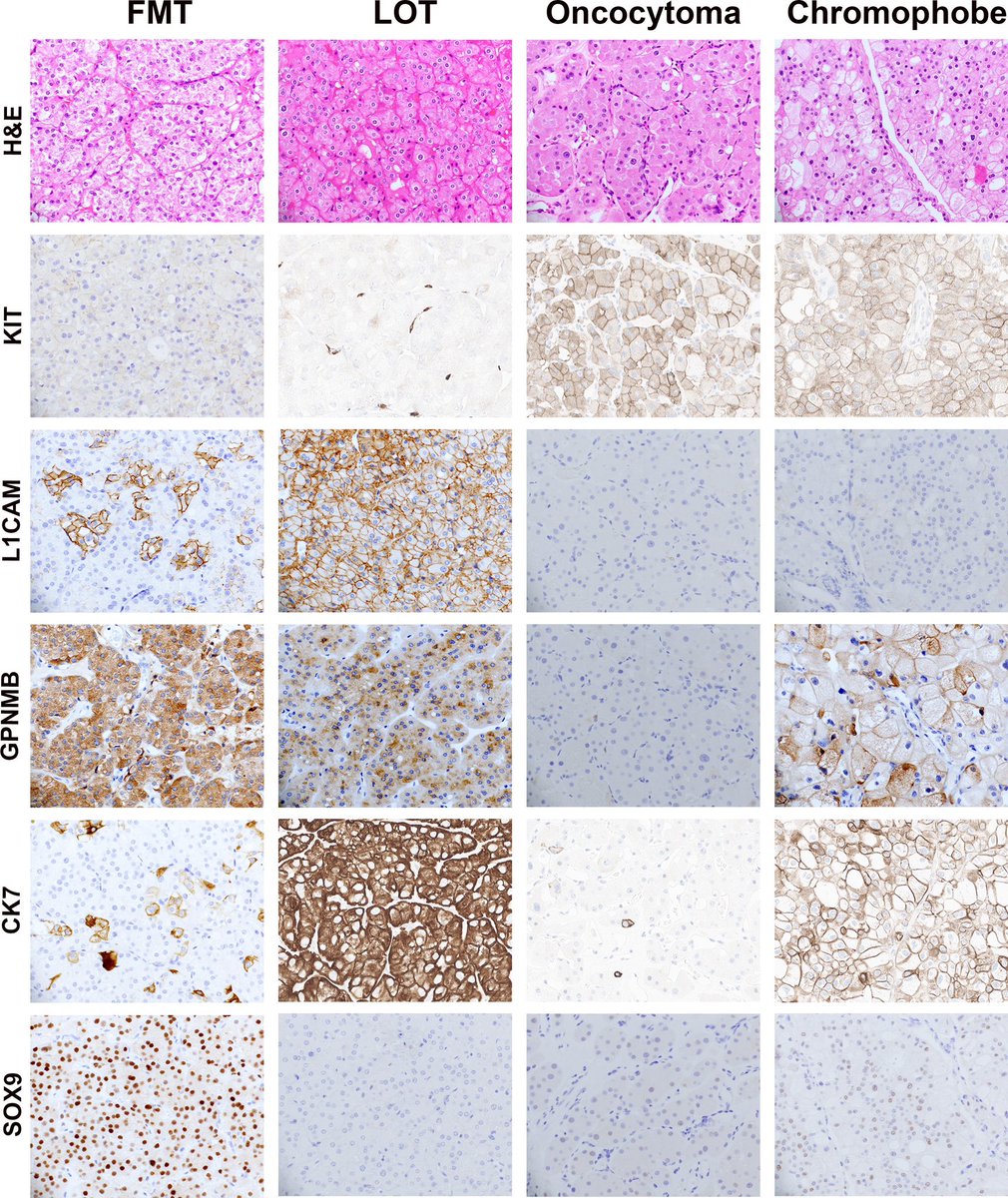 Sounak Gupta (@shounak_gupta) on Twitter photo Time to retire the “hybrid oncocytoma-chromophobe tumor” terminology?
<a href="/IntSocUropath/">International Society of Urological Pathology</a>, <a href="/GU_Path_Society/">GU Pathology Society (GUPS)</a>
kwnsfk27.r.eu-west-1.awstrack.me/L0/https:%2F%2… Time to retire the “hybrid oncocytoma-chromophobe tumor” terminology?
<a href="/IntSocUropath/">International Society of Urological Pathology</a>, <a href="/GU_Path_Society/">GU Pathology Society (GUPS)</a>
kwnsfk27.r.eu-west-1.awstrack.me/L0/https:%2F%2…