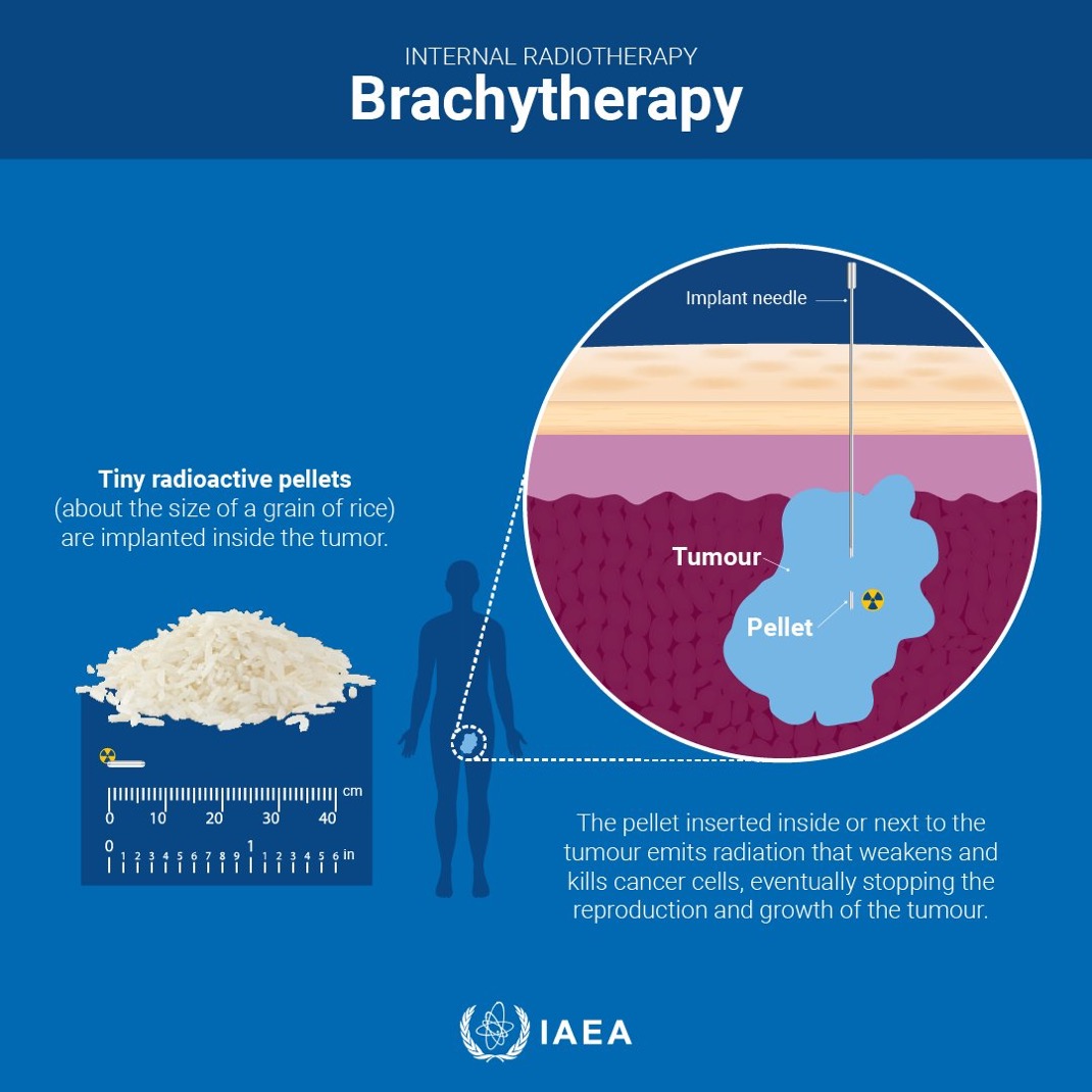 Brachytherapy is a type of radiotherapy where a tiny radioactive source is placed in the body, enabling a high dose of radiation to target the tumour while minimizing impact to nearby tissues.
Read #NuclearExplained to learn more: atoms.iaea.org/48y8chQ