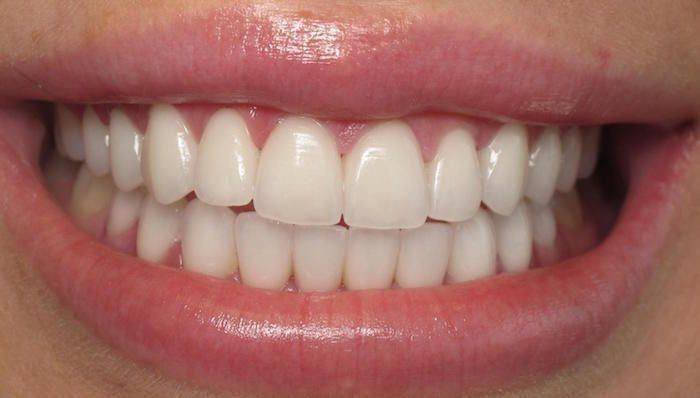 kalau tak mampu pergi dentist setahun 2 kali, at least mampukan diri beli electric toothbrush 🦷🪥

bersih sangat gigi lepas berus. hilang kotoran celah gigi, gigi pun makin cantik. let me explain cara guna dengan betul: