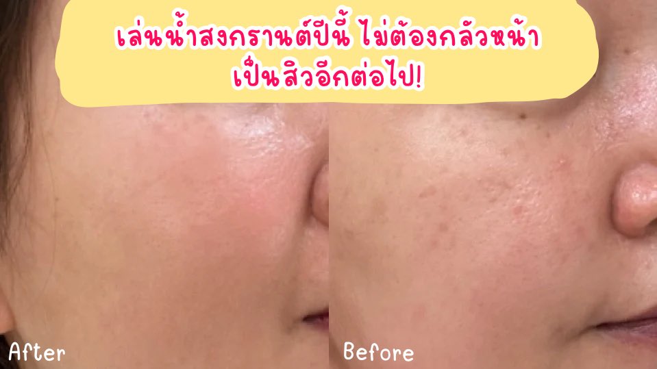เล่นน้ำสงกรานต์ปีนี้ ไม่ต้องกลัวหน้าเป็นสิวอีกต่อไป เพราะมีตัวช่วยดีๆ อย่าง Jelly Me ZinC ที่ช่วยลดการเกิดสิว ให้หน้าเป๊ะปัง หอมกลิ่นพีช อร่อยสุดๆ ยิ่งไปแช่เย็นยิ่งอร่อย สงกรานต์นี้จะโดนสาดน้ำปะแป้งกี่ครั้งก็ไม่หวั่นกลัวหน้าเป็นสิวอีกต่อไป สนุกได้เต็มที่!📍พิกัด 7-11 ทุกสาขา

#JellyMeCuti #ความคิวทิบิลด์ง่ายได้ทุกวัน #JellyMeZinc #ลดสิว #ดีบอกต่อ