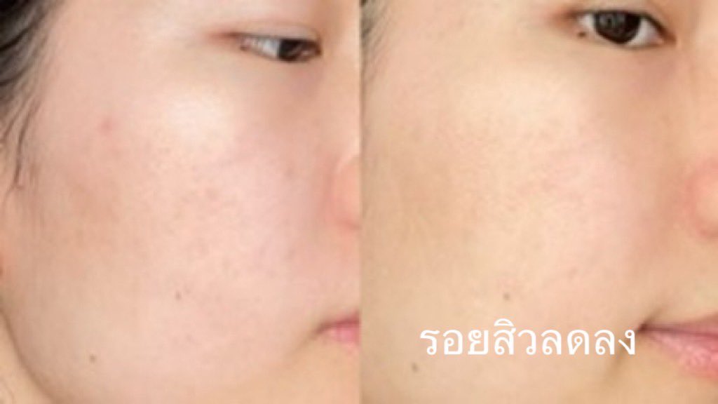 กรี๊ดดมากแม่คือติ่งผชยังไงให้สิวหายด้วย เรื่องคือแม้กณฐเขาใช้โฟมล้างหน้าลดสิวของ Mentholatum หลอดเขียวด้วยอะ💚คือใช้อยู่แล้ว ทับใจมากก ใช้ตั้งแต่ตอนเป็นนักเรียนเลย ลดสิวดีงามสุด เนื้อโฟมละเอียด ล้างสะอาด สิวลดจริง ช่วยให้หน้ามันน้อยลง หน้าใสสิวหายไวจริง ✨
พิกัด : https://t.co/DyCp3iXY5t