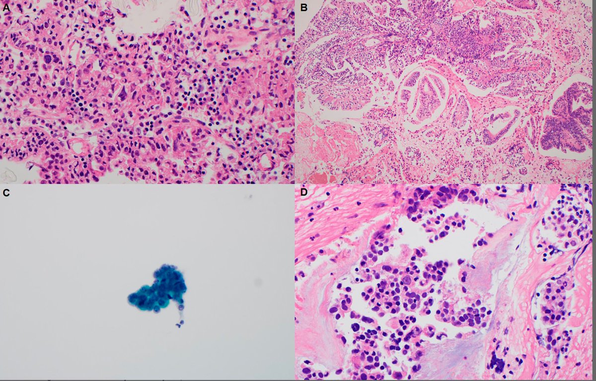 Diagnostic Cytopath (@diagnosticcyto) on Twitter photo New article alert! <a href="/DiagnosticCyto/">Diagnostic Cytopath</a> "Comprehensive Approach to Cytomorphology in Liquid-Based Bile Duct Brush Cytology: Integrating Cell Blocks and Histology" <a href="/PapSociety/">Papanicolaou Society</a> <a href="/IACytology/">International Academy Cytology</a>
onlinelibrary.wiley.com/doi/10.1002/dc… <a href="/aakasharmand/">Zubair Baloch</a> <a href="/AzizaNassar2/">Aziza Nassar</a> New article alert! <a href="/DiagnosticCyto/">Diagnostic Cytopath</a> "Comprehensive Approach to Cytomorphology in Liquid-Based Bile Duct Brush Cytology: Integrating Cell Blocks and Histology" <a href="/PapSociety/">Papanicolaou Society</a> <a href="/IACytology/">International Academy Cytology</a>
onlinelibrary.wiley.com/doi/10.1002/dc… <a href="/aakasharmand/">Zubair Baloch</a> <a href="/AzizaNassar2/">Aziza Nassar</a>
