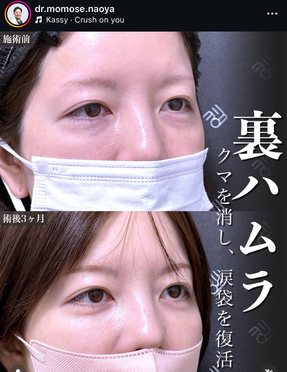 百瀬先生の涙袋を意識した裏ハムラ完璧すぎる...涙袋に悩む民に届け...‼︎