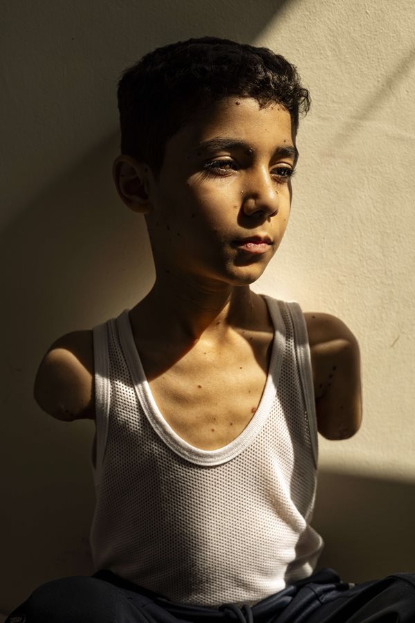 AllasAnchal's tweet photo. The image of Mahmoud Ajjour (9) injured in an Israeli attack on Gaza in March 2024, taken by Doha-based Palestinian photographer Samar Abu Elouf for New York Times has been nominated as the Photo Of The Year 2025.

It is such an irony - the best shows the worst of humanity. https://t.co/Hd5vxyibXS