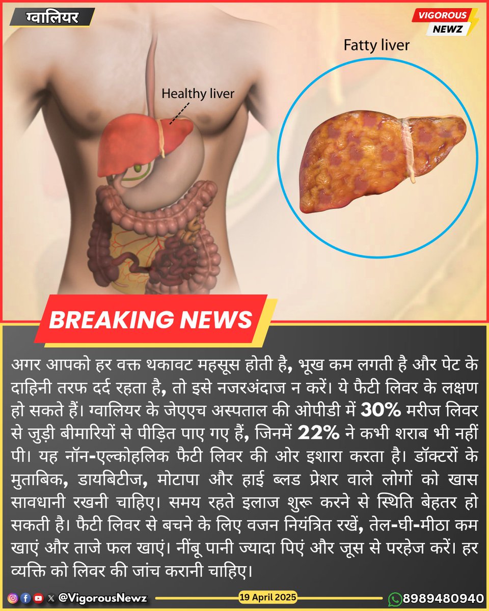 VigorousNewz's tweet image. #ग्वालियर #Gwalior #LiverProblem #FattyLiver #NonAlcoholicFattyLiver #LiverCare #HealthAlert #ThakavatAurKamBhukh #PetDard #LiverCheckup #LiverDiseaseAwareness #DiabetesAurFattyLiver #BPAndLiverRisk #HealthyLiverTips #VigorousNewz #VigorousNewzGwalior #VigorousNewzGwaliorUpdate