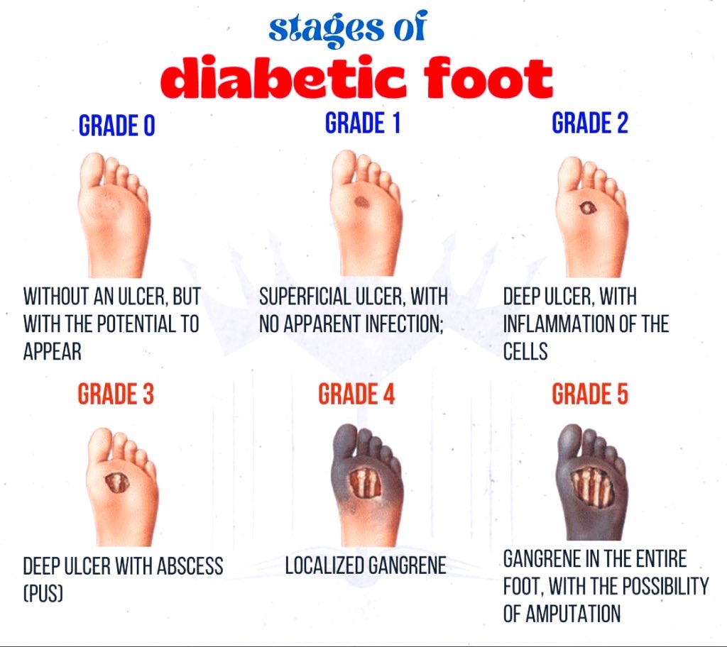 Doctors__squad's tweet photo. Stages of diabetic foot https://t.co/uK3KfuH0wN