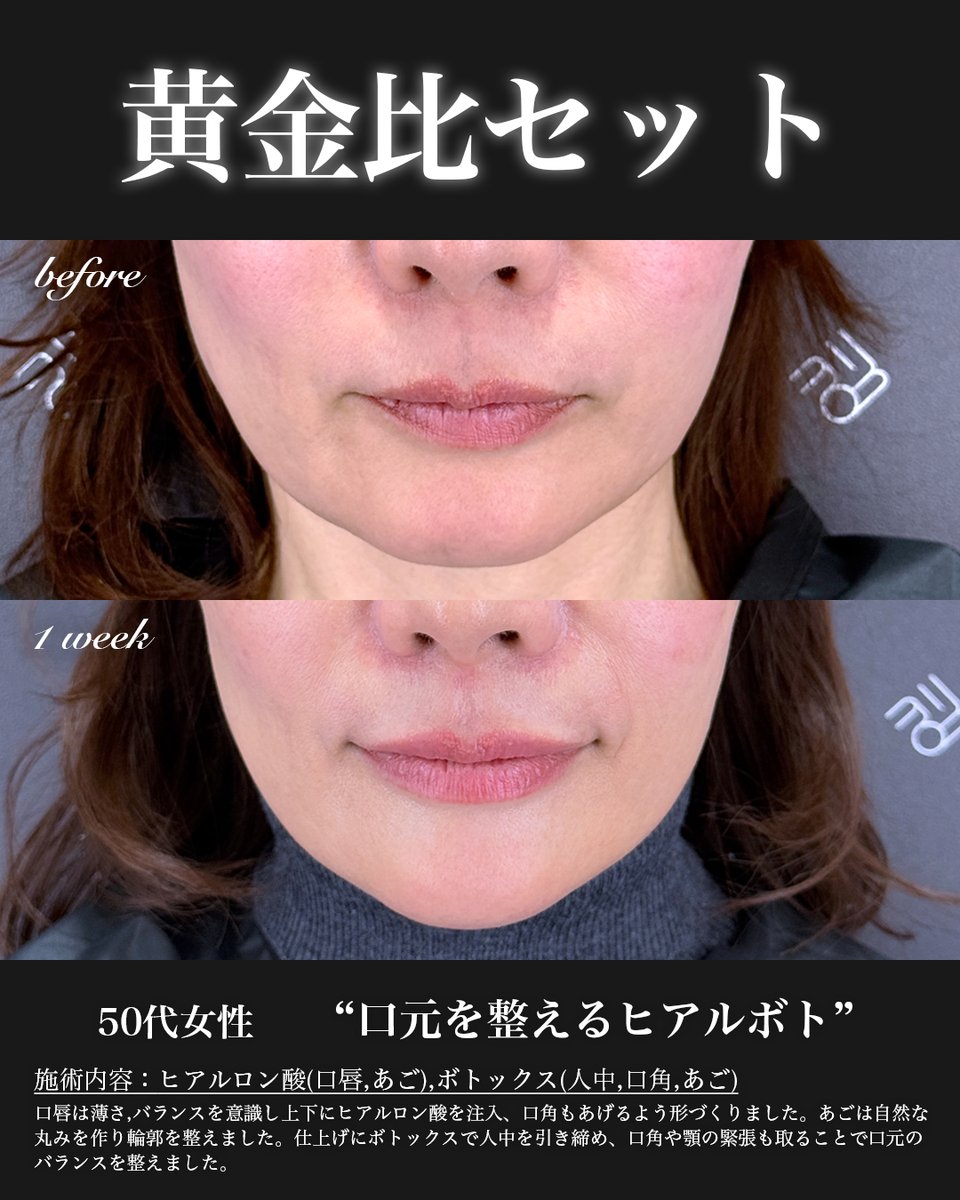 『唇が薄い』『口角が下がってる』『あごの形が気になる』
そんな“なんとなく老けて見える”口元、
ヒアルロン酸×ボトックスで整えると、こんなに変わります👇✨

✅ 唇はふっくら
✅ 口角が自然に上がる
✅ あごのバランスもスッキリ

ナチュラルに可愛い“下顔面美人”にしたい方、黄金比セットです☝️