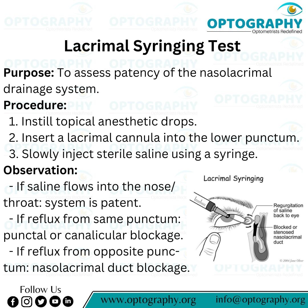 Optography8's tweet image. Lacrimal syringing: A quick and effective test to trace tear drainage blockages!
#LacrimalSyringing #Epiphora #TearDrainage #NasolacrimalDuct #Optography #Optometry #EyeCare #Dacryocystitis  #Thatoptometrist