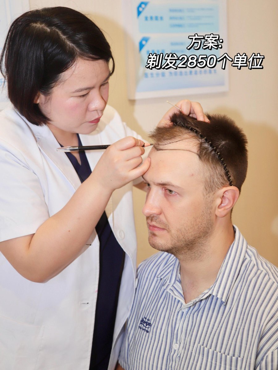 rain79050853's tweet photo. 🔴 BEFORE: Patchy hair, low confidence
🟢 AFTER: Thick hairline, natural results
He regained his hair (& smile) in 8 hours.
You can too. 
-
Consult me ​​about hair transplantation:         
WeChat: yhzfyl2005          
WhatsApp consultation: https://t.co/7Df8roApcx 
#hairtransplant #hairloss #thinninghair #yonghe #Malebaldness #hairstyle #hairgrowth #Hair