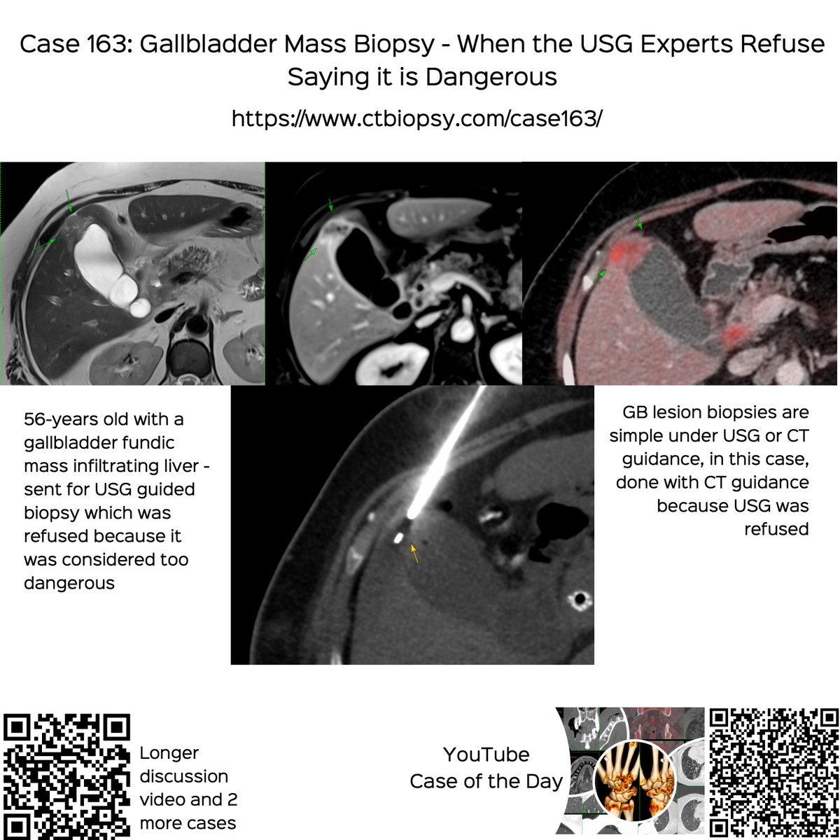 bhavinj's tweet photo. Case 163: Gallbladder Mass Biopsy - When the USG Experts Refuse
56-yrs old with a fundic gallbladder mass. USG guided biopsy refused.
The video explains the case and the biopsy with other examples of CT guided gallbladder biopsies
https://t.co/Bxnn9rusE7
#ctbiopsy #irrad #gallbladder #gallbladderbiopsy