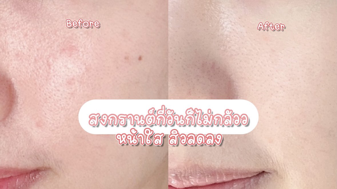 จะสงกรานต์กี่วันก็ไม่กลัว โดนสาดน้ำ โดนแป้งดินสอพองทางนี้ไม่หวั่น เพราะมีตัวช่วยดีๆอย่าง Jelly Me ZinC เจลลี่ลดสิว ที่ทั้งอร่อย หอมกลิ่นพีช 🍑 แถมสิวลดลง ยิ่งแช่เย็นยิ่งฟินมากก เนื้อเจลลี่ใสนุ่มเด้งเคี้ยวเพลิน น้ำตาล0% ด้วย ราคาซองละ 20.-❣️พิกัด 7-11 ทุกสาขาเลยน้าา💓

#JellyMe #JellyMeCuti #ความคิวทิบิลด์ง่ายได้ทุกวัน #JellyMeZinc #ลดสิว #HowtoPerfect